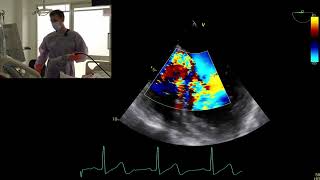 Live scan TOE severe aortic regurgitation bicuspid valve infective endocarditis [upl. by Halak193]