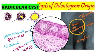 Radicular Cyst  Periapical cyst  HISTOPATHOLOGY  Clinical features  Etiopathogenesis [upl. by Sutherland340]