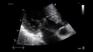 HYPERTROPHIC CARDIOMYOPATHY ECHOCARDIOGRAM  SAM [upl. by Notyard]