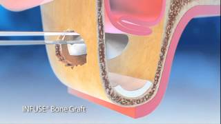 How Bone Graft Works 2 [upl. by Irrabaj]