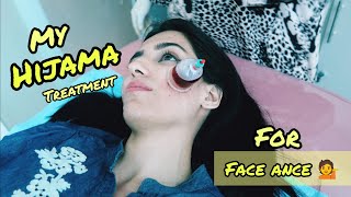 Hijama Treatment for Face Acne  Nida Gul Khan  My First Hijama Cupping [upl. by Narad]