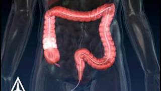 Colonoscopy  3D Medical Animation [upl. by Nahtanaoj851]