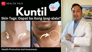 Kuntil Skin tags dapat ba itong ipagalala [upl. by Malina]