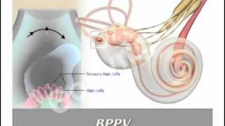 BPPV and Epleys Maneuver [upl. by Udella937]