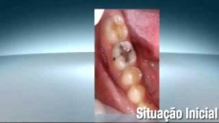 Substituição de restaurações metálicas [upl. by Handbook]