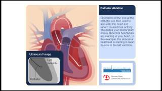 Catheter Ablation Animation Video [upl. by Teddie783]