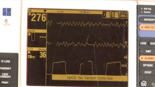 Waveform capnography demonstration [upl. by Notgnillew]