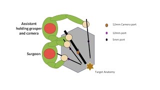 Learning Laparoscopic Sigmoid Colectomy High Anterior Resection [upl. by Llerrem]