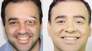 COMO COBRIR VITILIGO COM MAQUIAGEM [upl. by Holub]