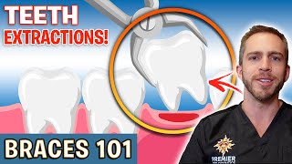 BRACES 101 Tooth Extractions For Braces  Treatment Minute Talk [upl. by Aillicsirp]