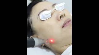 PICO Hybrid Laser Singapore v2  Ace MediAesthetics Clinic [upl. by Gokey]