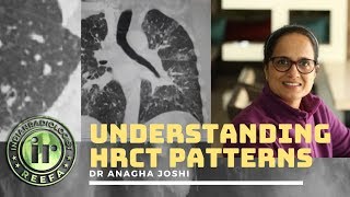 Understanding Lung HRCT patterns  Dr Anagha Joshi  Nodules amp Septal Thickening [upl. by Dorine]