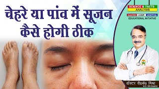 चेहरे या पांव में सूजन कैसे होगी ठीक  HOW FLUID RETENTION AFFECTS DIFFERENT PARTS OF YOUR BODY [upl. by Giarc]