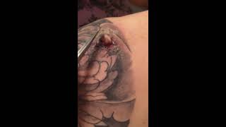 Infected abscess on tattoo [upl. by Gaylord]