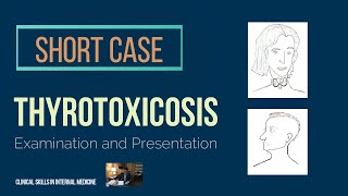 Thyrotoxicosis  Short Case [upl. by Kristine866]