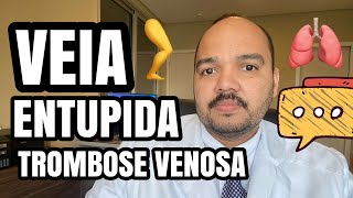 VEIA ENTUPIDA Primeiros sintomas de TROMBOSE VENOSA COMO IDENTIFICAR A VEIA ENTUPIDA [upl. by Otiv]