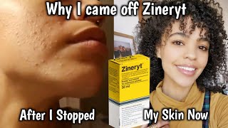 Why I Came Off Zineryt  Did My Acne Come Back [upl. by Case]