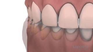 Gingivoplastie et gingivectomie  Centres dentaires Lapointe [upl. by Yentterb]