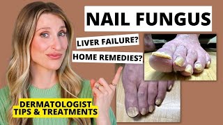 Dermatologist Shares Treatments for Nail Fungus amp Prevention Tips  Dr Sam Ellis [upl. by Simmonds]