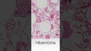 Hibernoma  histology [upl. by Sidonia]