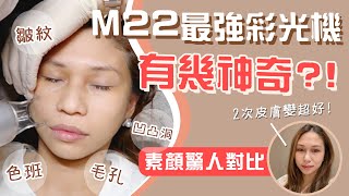 【😱超驚人】M22彩衝光Before amp After．頂尖醫療級光學儀器🤩改善皮膚實錄：膠原再生、去紋去黃、收毛孔、去色班暗瘡凹凸洞｜點用FDA分優質儀器｜ft Oneness｜醫學美容｜非廣告 [upl. by Lal]