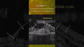 Choroidal neovascularization in recurrent toxoplasmosis [upl. by Etterb96]