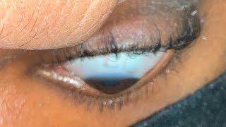 CHANDRA HOA SCLERALS for Keratoconus [upl. by Liew529]