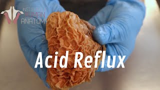 What Is Acid Reflux [upl. by Aserret]