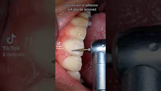 Polishing teeth after bracket removal  Braces Removal [upl. by Dalt]