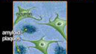 Understanding Alzheimers Disease Alzheimers 1 [upl. by Htaek]