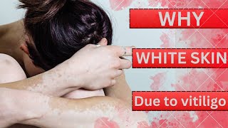 SARIR PAR SAFED DAAG KYU AATA HAI  WHITE PATCHES ON BODY  VITILIGO KYA HOTA HAI [upl. by Eellac]