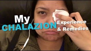 My Chalazion Experience amp Remedies [upl. by Ree]