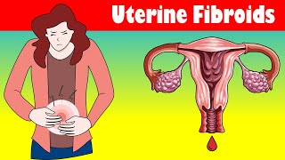 Uterine Fibroids Signs And Symptoms Types Causes And Treatment [upl. by Aicatsan]