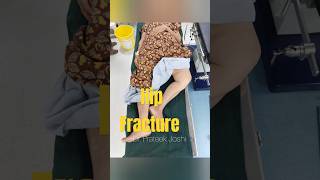 Hip Fracture Surgery  Intertrochanteric Fracture Femur  Proximal Femur Nail  Dr Prateek Joshi [upl. by Alika]