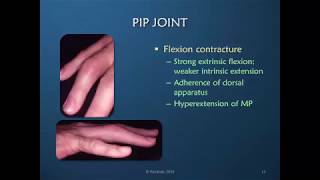 Obstinate PIP Joint Part 1 of 12 Anatomy amp Normal Mechanics [upl. by Anitselec]