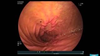 Obstructive Small Bowel Crohns Disease in Balloon Enteroscopy [upl. by Cirilo]