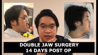 Jaw Surgery Post Op Before and After  Day 1 to 14 Week 1 and 2  Recovery Experience Underbite [upl. by Starlin160]