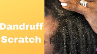 Dandruff scratch on dreadlocks [upl. by Bloomer]