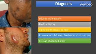 actinomycosis  causes diagnosis treatment comp [upl. by Lupe852]