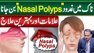 Gadood in Nose OR Nasal Polyps  Symptoms and Treatment of Nasal Polyps  Nose Polyps Ka ilaj [upl. by Anielram444]