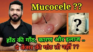 Mucocele होंठ की गांठ के कारण और इलाज [upl. by Zacek]