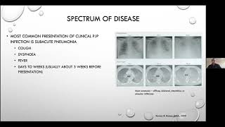 Pneumocystis jirovecii pneumonia  Current Issues in its Management [upl. by Levesque231]