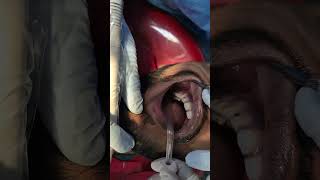 TEETH SCALING  TEETH CLEANING  HOW TOOTH SCALING IS DONE  ORAL PROPHYLAXIS [upl. by Garcon]