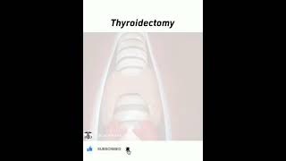 Thyroidectomy or Thyroid Removal Surgery 💉💊🩹🩺 [upl. by Maya741]