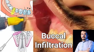 Local Anesthesia Buccal Infiltration Technique Maxillary Anesthesia Techniques dentistry [upl. by Aslam]