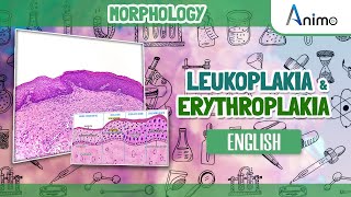 Leukoplakia and Erythroplakia  GIT Morphology  English [upl. by Scevour]