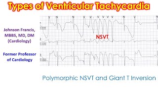 Types of Ventricular Tachycardia [upl. by Valsimot]