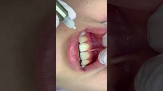 Infiltration anesthesia of the central incisors  Инфильтрационная анестезия центральных резцов [upl. by Tizes490]