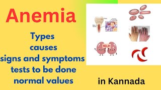 AnemiaTypescausessignsin KannadaBmltDMLT [upl. by Eissert]