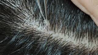 Relaxing dandruff removal w tweezers 15 02sleepyheads  visual ASMR oddlysatisfying [upl. by Daney]